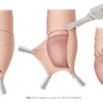 Insights on Routine Male Circumcision