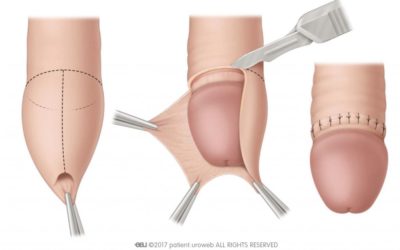 Insights on Routine Male Circumcision